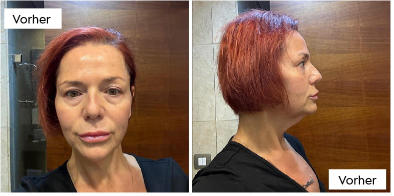 Halslift mit Platysmaplastik: Wie Chirurgen den „Truthahnhals“ beseitigen 5 What Does Neck Lift Recovery Look Like Week by Week DE What Does Neck Lift Recovery Look Like Week by Week DE