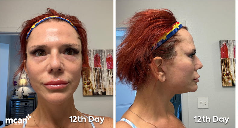 What Does Neck Lift Recovery Look Like Week by Week EN copy 2