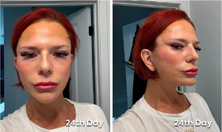 What Does Neck Lift Recovery Look Like Week by Week EN copy 3