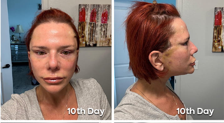 What Does Neck Lift Recovery Look Like Week by Week EN copy