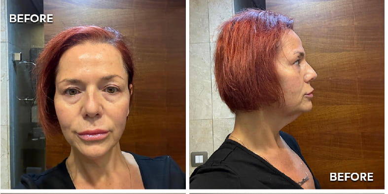 What Does Neck Lift Recovery Look Like Week by Week EN