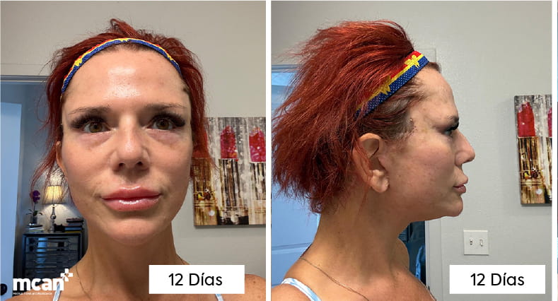 Lifting de cuello con platismaplastia: cómo los cirujanos eliminan el «cuello de pavo» 7 What Does Neck Lift Recovery Look Like Week by Week ES copy 2 What Does Neck Lift Recovery Look Like Week by Week ES copy 2