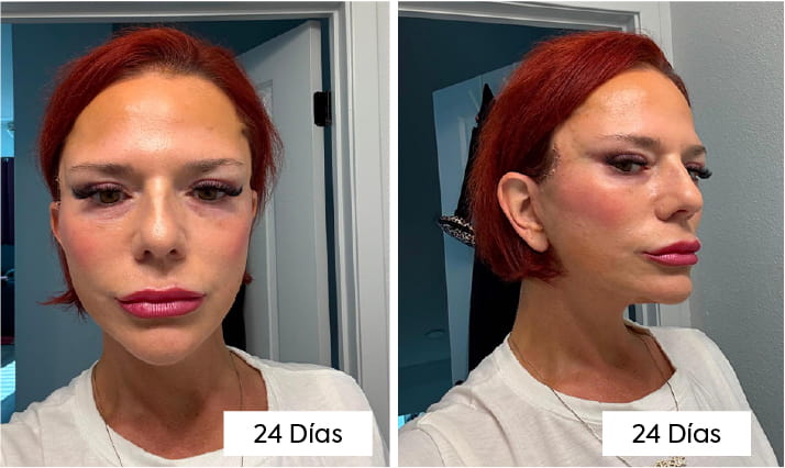 Lifting de cuello con platismaplastia: cómo los cirujanos eliminan el «cuello de pavo» 8 What Does Neck Lift Recovery Look Like Week by Week ES copy 3 What Does Neck Lift Recovery Look Like Week by Week ES copy 3