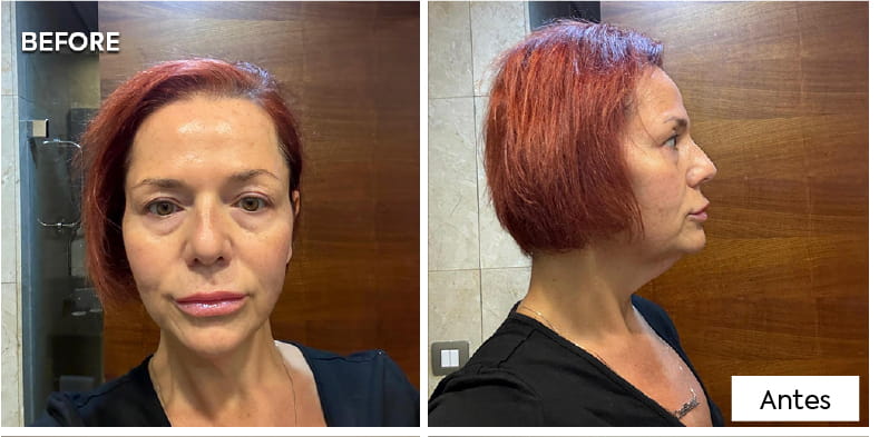 Lifting de cuello con platismaplastia: cómo los cirujanos eliminan el «cuello de pavo» 5 What Does Neck Lift Recovery Look Like Week by Week ES What Does Neck Lift Recovery Look Like Week by Week ES