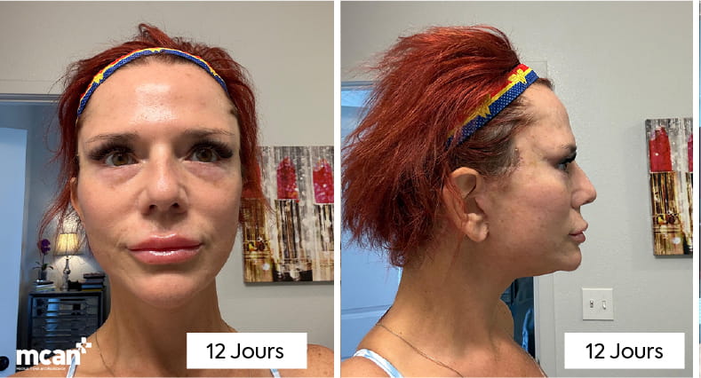 Lifting du cou avec platysmaplastie : comment les chirurgiens éliminent le « cou de dinde » 7 What Does Neck Lift Recovery Look Like Week by Week FR copy 2 What Does Neck Lift Recovery Look Like Week by Week FR copy 2