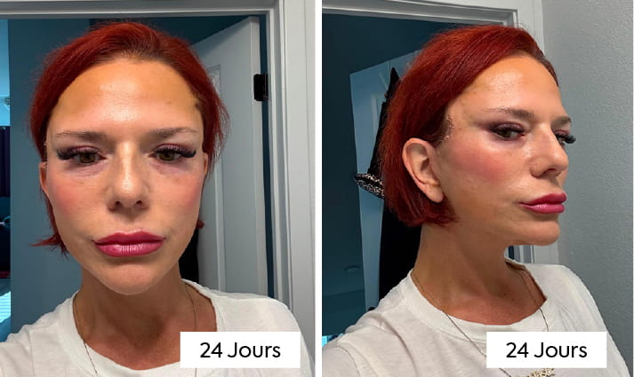 Lifting du cou avec platysmaplastie : comment les chirurgiens éliminent le « cou de dinde » 8 What Does Neck Lift Recovery Look Like Week by Week FR copy 3 What Does Neck Lift Recovery Look Like Week by Week FR copy 3