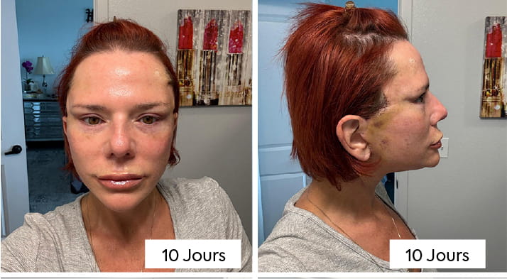Lifting du cou avec platysmaplastie : comment les chirurgiens éliminent le « cou de dinde » 6 What Does Neck Lift Recovery Look Like Week by Week FR copy What Does Neck Lift Recovery Look Like Week by Week FR copy