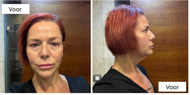 Halslift met platysmaplastiek: hoe chirurgen een „kalkoenhals” verhelpen 5 What Does Neck Lift Recovery Look Like Week by Week NL What Does Neck Lift Recovery Look Like Week by Week NL