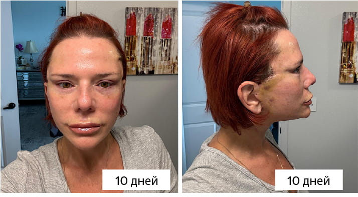 Подтяжка шеи с платизмапластикой: как хирурги устраняют «индюшачью шею» 6 What Does Neck Lift Recovery Look Like Week by Week RU copy What Does Neck Lift Recovery Look Like Week by Week RU copy