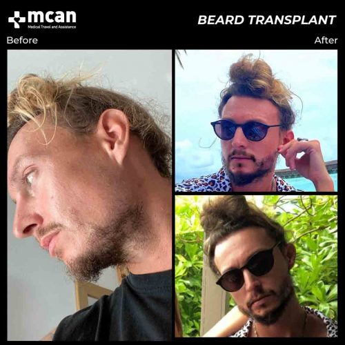 Dan-beard-transplant-in-turkey