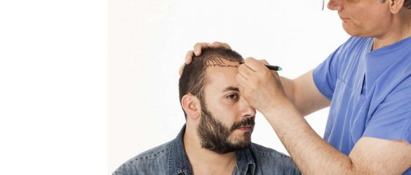 Hair-Transplant-UK