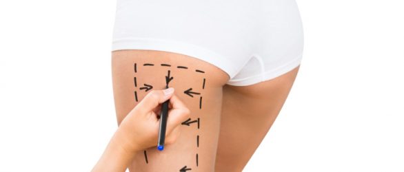 Thigh Lift in Turkey