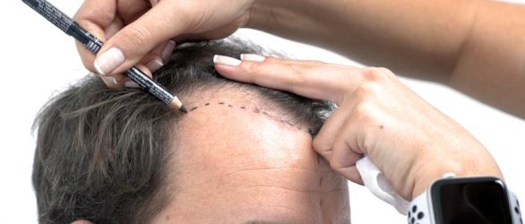 hair-transplant-turkey