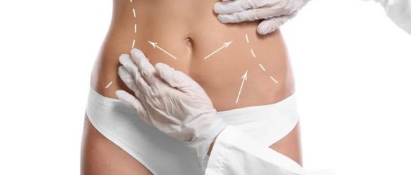 liposuction-in-turkey