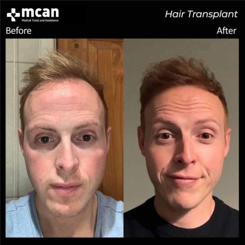 transplant-in-turkey-before-after-02.jpg