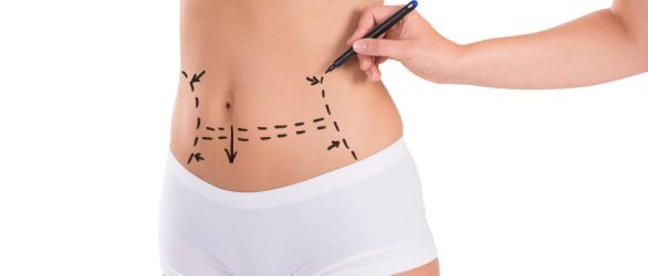 Tummy Tuck in Turkey | Aftercare Instructions
